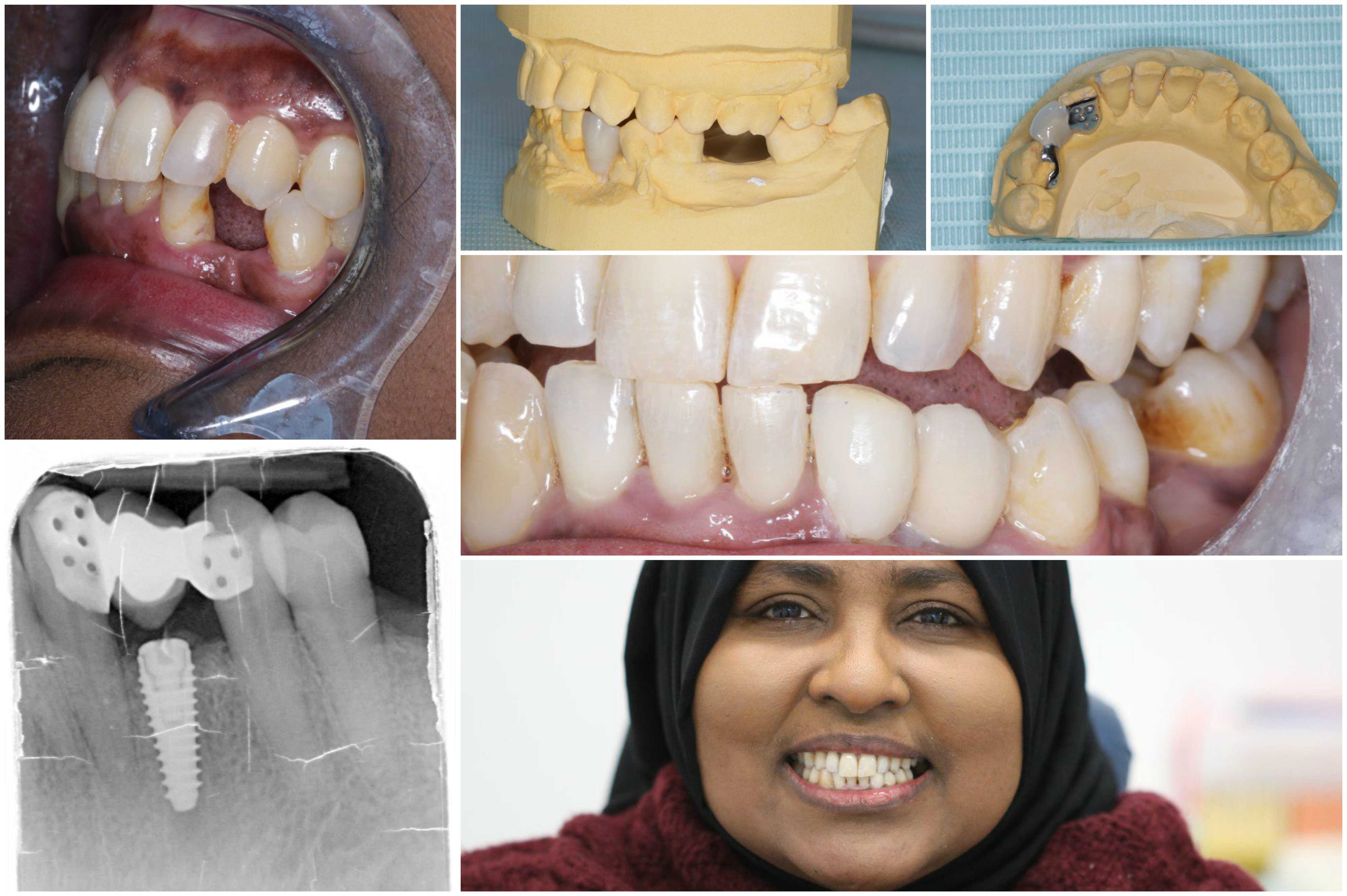 SINGLE IMPLANT Green lane Dental Centre