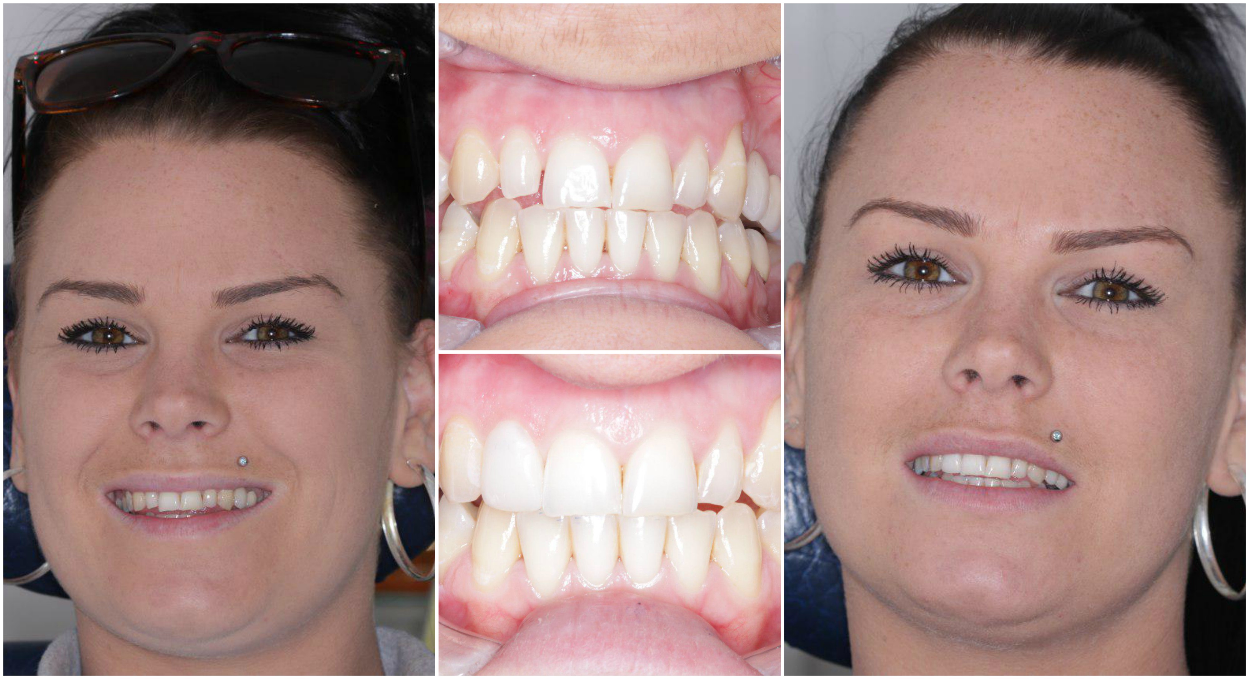 SINGLE VENEER Green lane Dental Centre