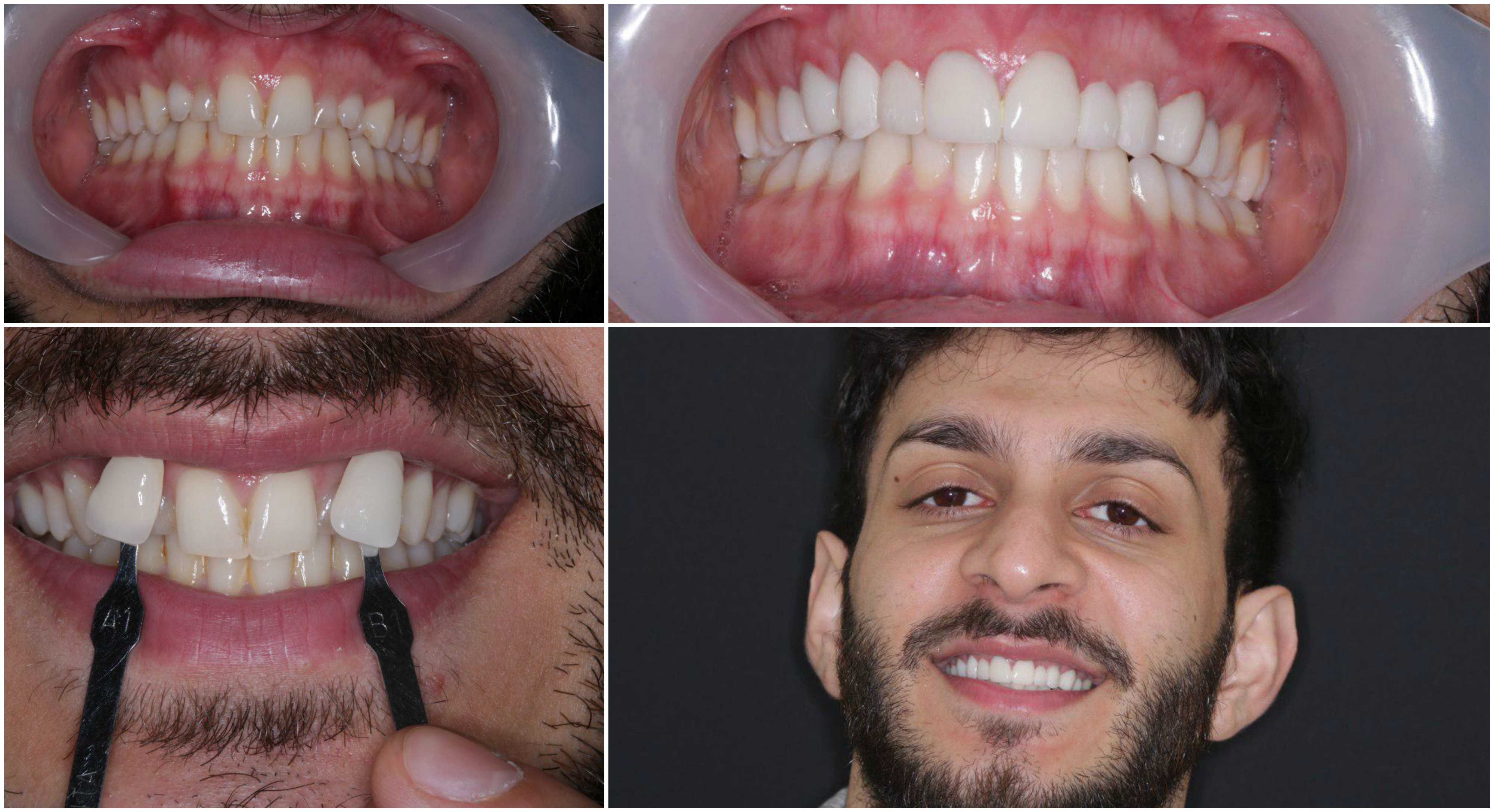 SMILE MAKE OVER BY VENEER Green lane Dental Centre