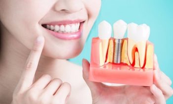 ALL YOU NEED TO KNOW ABOUT DENTAL IMPLANTS