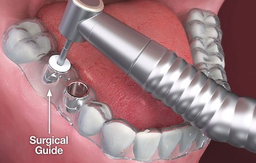 Implant Placement By Surgical Guide - Green Lane Dental Centre