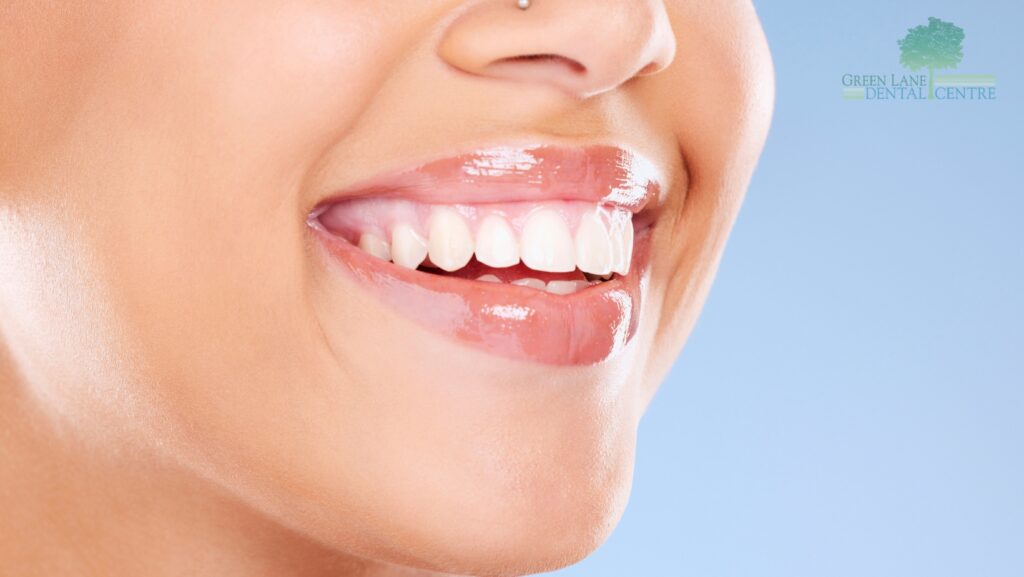 Professional Teeth Whitening in Penge for a bright and confident smile.