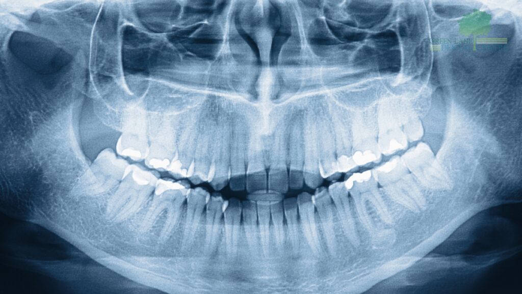 A 3D X-ray (CBCT Scan) showing precise planning for implant placement in Penge.