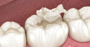 White fillings in Penge applied to restore a decayed tooth 