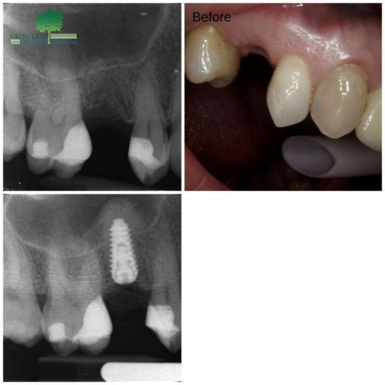 dental implants case 21 - 4th image coming soon