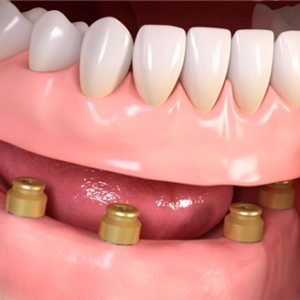 implant supported dentures London dentist