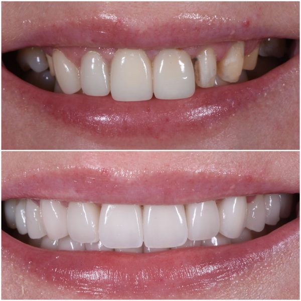 teeth whitening 2
